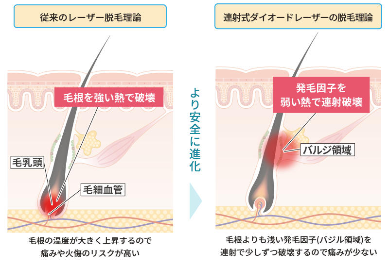 長期減毛用ダイオードレーザー